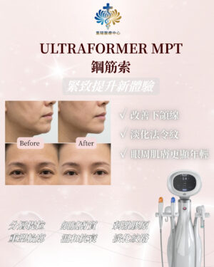 Ultraformer MPT 鋼筋索