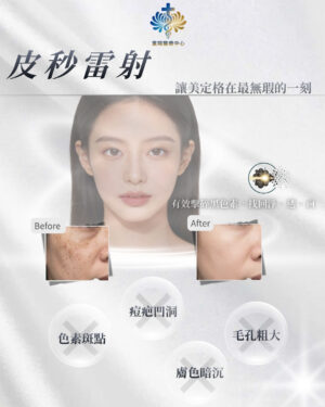 皮秒雷射